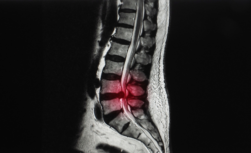 Degenerative Disc Disorder